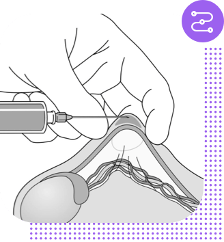 No-scalpel vasectomy procedure, step 1