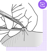 No-scalpel vasectomy procedure, step 2