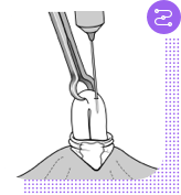 No-scalpel vasectomy procedure, step 4