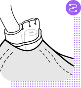 No-scalpel vasectomy procedure, step 5