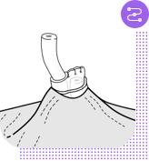 No-scalpel vasectomy procedure, step 6